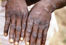 Mpox