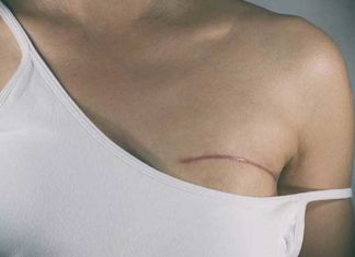 Cancer du sein : la reconstruction mammaire est gratuite en Tunisie