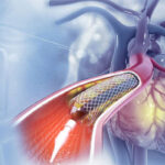 Tunisie : un cahier des charges national pour l’achat des stents cardiaques